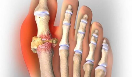 A Closer Look at Gout: Causes and Treatments