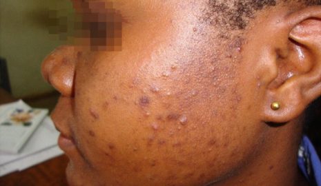 How to Manage Acne in Women