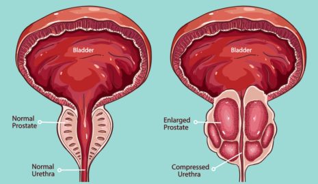 Understanding the Early Signs of Prostate Cancer