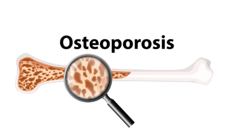 The Importance of Regular Osteoporosis Screenings