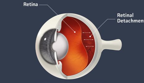 How to Recognize Early Signs of Retinal Detachment