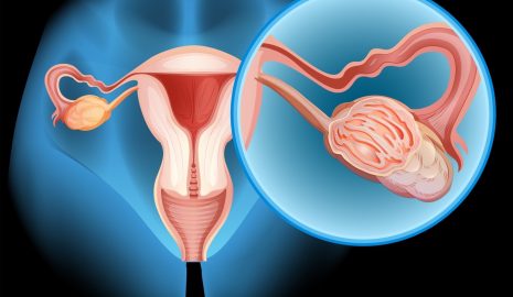 The Importance of Regular Ovarian Cancer Screenings for Women