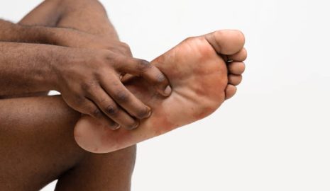 How to Prevent and Treat Athlete’s Foot in Men