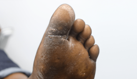 How to Prevent and Treat Calluses in Men