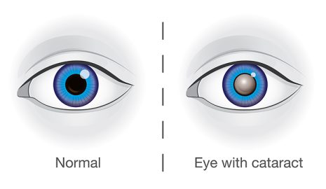 How to Recognize Early Signs of Cataracts