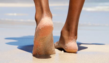 How to Prevent and Treat Cracked Heels in Women