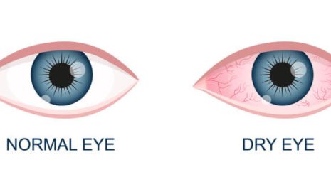 How to Recognize Early Signs of Dry Eye Syndrome