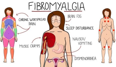 How to Cope with Fibromyalgia