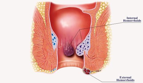 Understanding Haemorrhoids: Causes, Symptoms, Treatment, and Prevention