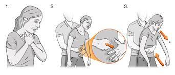 How to Administer the Heimlich Maneuver in Choking Situations