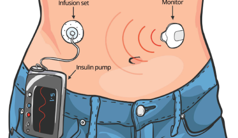 How to Use Insulin Pumps Correctly