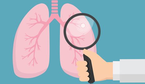 The Importance of Regular Lung Cancer Screenings for Women