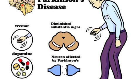 The Role of Diet in Parkinson’s Prevention