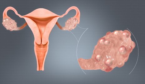 A Guide to Understanding Polycystic Ovary Syndrome (PCOS)