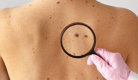 The Importance of Regular Skin Cancer Screenings