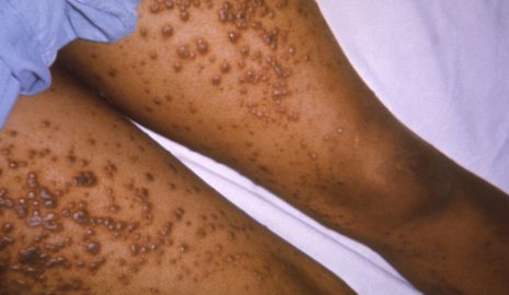 The Importance of Chickenpox Vaccination