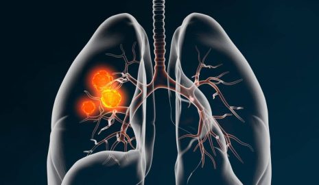 The Link Between Smoking and Lung Cancer in Men